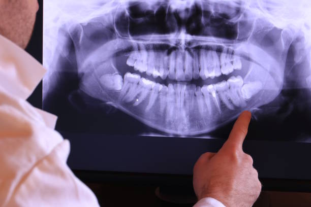 Best Emergency Wisdom Tooth Extraction in Jonestown, PA